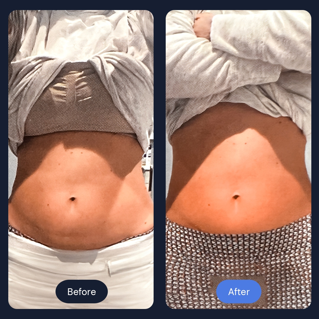 Real client before and after fat reduction cryotherapy results, front view