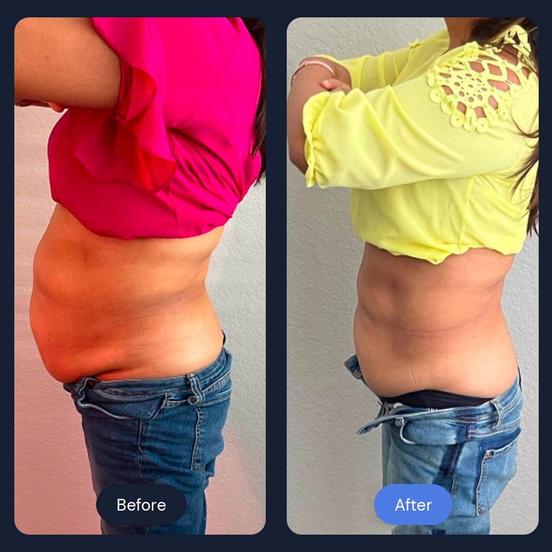 Real client before and after fat reduction cryotherapy results, side view